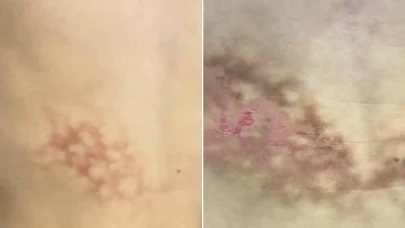 Laptopla Sıcak Sandalyede Çalışanlar Dikkat: 'Kızarmış Cilt Sendromu' Tehlikesi!