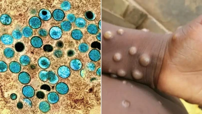 Salgın kontrolden çıkıyor! Korkutan bilanço açıklandı: 40’tan fazla şehre yayıldı, can kayıpları artıyor