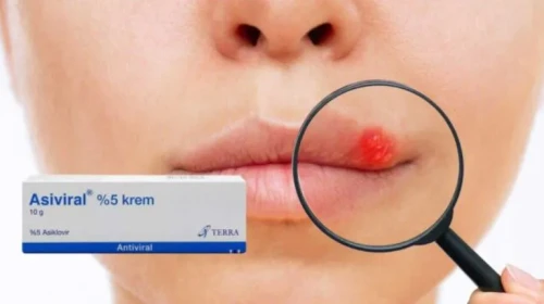 Asiviral Krem Ne İşe Yarar? Nasıl Kullanılır? Asiviral Krem Fiyatı Ne Kadar? Kullananlar Ne Diyor?