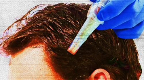 Mikroiğneleme Nedir ve Gerçekten Saç Dökülmesini Önler mi?