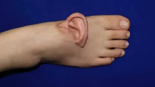 Tıpta Devrim Yaratan Uygulama: Kulak Geçici Olarak Ayak Bölgesine Aktarıldı!