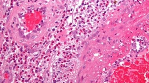 Yaralardaki İltihaplanmayı Giderecek Etkili Yöntemler!