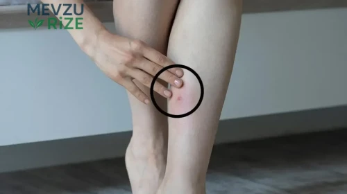 Bacaklarınızdaki Pire ve Böcek Lekelerini Gidermenin Üç Etkili Yöntemi