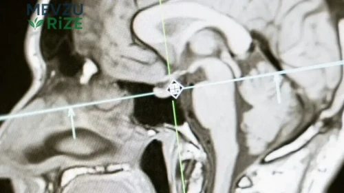 Alzheimer ve Parkinson Araştırmalarında Yeni Gelişmeler: Umut Verici Bulgular!