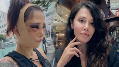 Survivor Didem Ceran'ın Güney Kore'de geçirdiği estetik operasyon sonrası yeni bir ameliyat gündeme geldi!