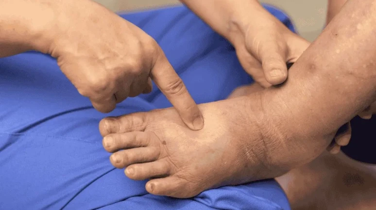 Dizde Ödem ve Şişlik Sorunlarında Erken Müdahale Büyük Önem Taşıyor!