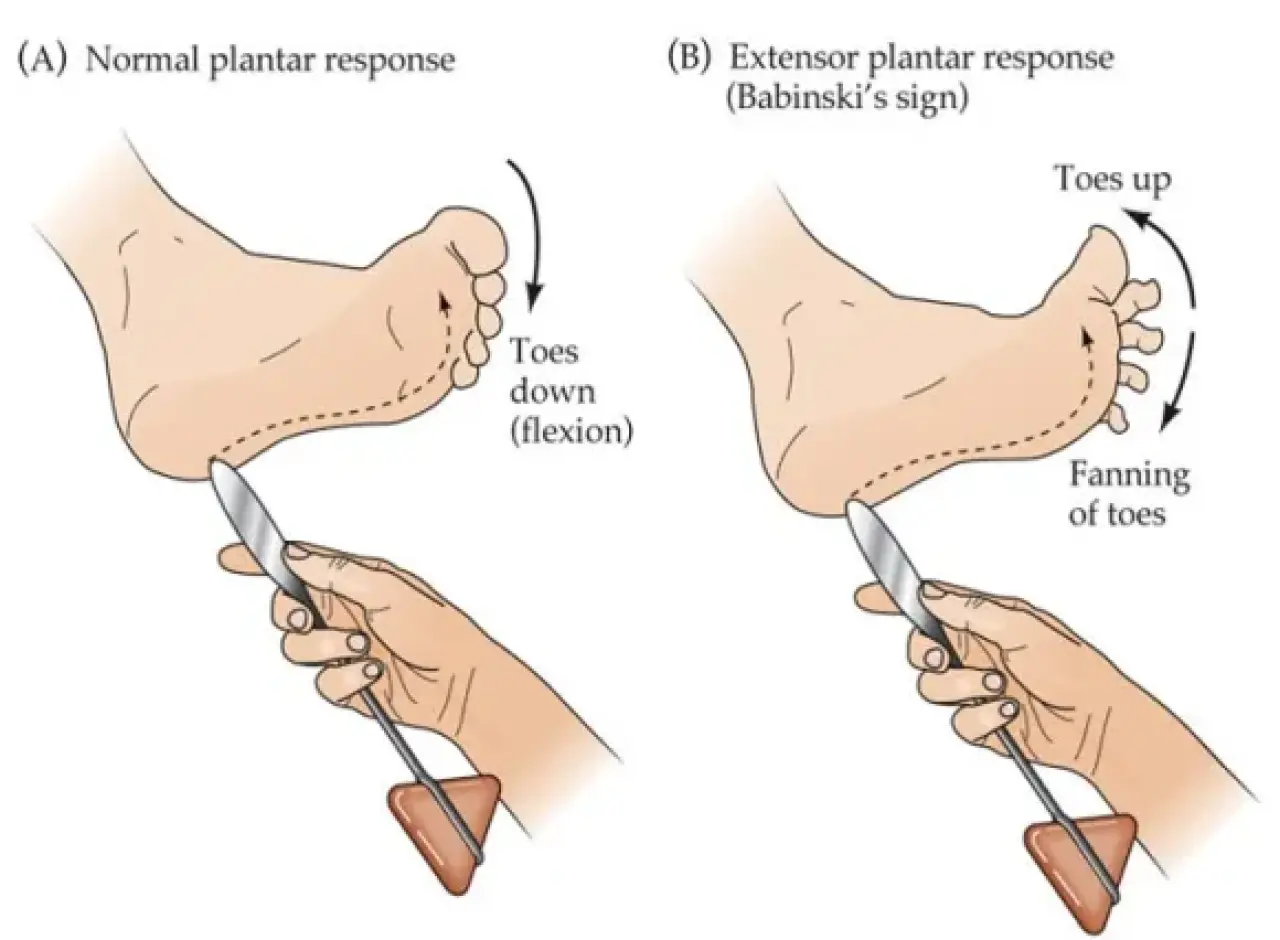 Babinskis Sign.jpg